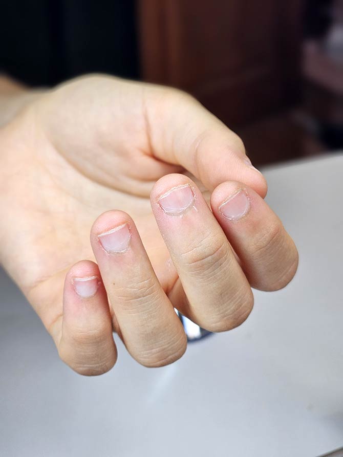 Uñas con Onicofagia (antes)